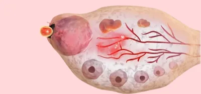 Advanced IVF treatment service at IVF hospital in Delhi