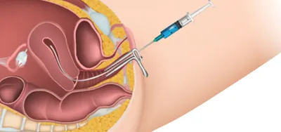 Egg freezing service at IVF hospital in Delhi