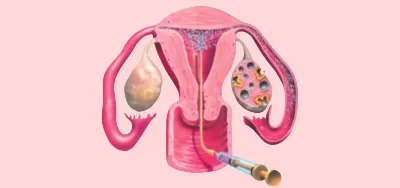 Sperm freezing service by IVF doctor in Delhi